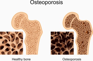 Faktor Penyebab Penyakit Osteoporosis
